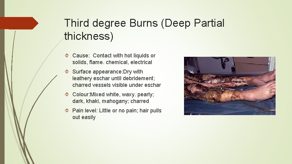 Third degree Burns (Deep Partial thickness) Cause: Contact with hot liquids or solids, flame.