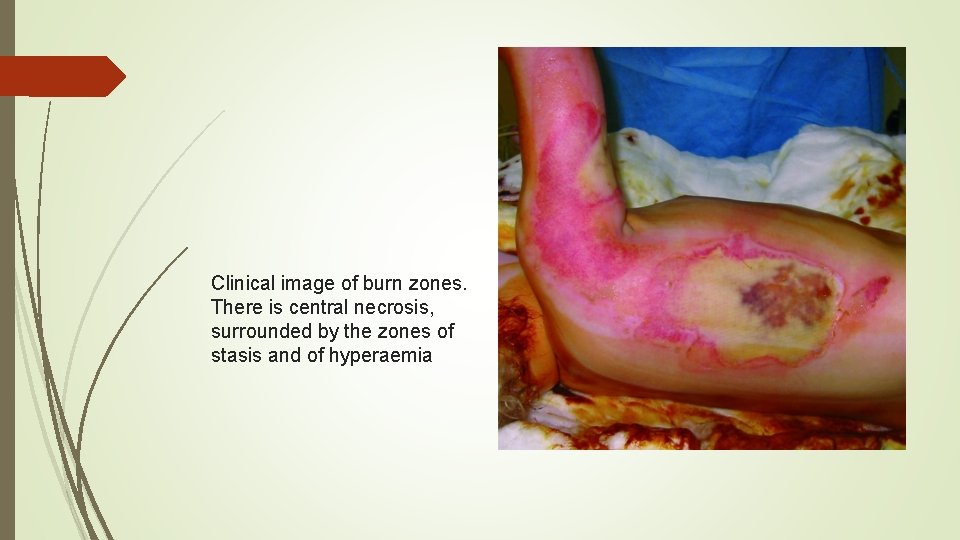 Clinical image of burn zones. There is central necrosis, surrounded by the zones of