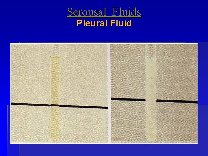 Serousal Fluids Pleural Fluid 