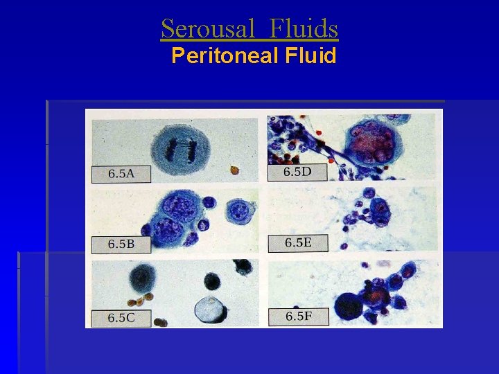 Serousal Fluids Peritoneal Fluid 