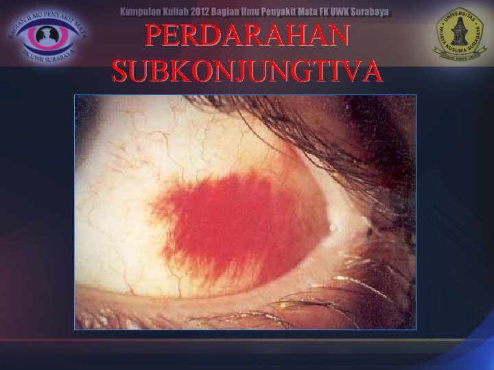 PERDARAHAN SUBKONJUNGTIVA 