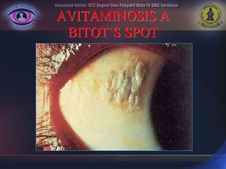 AVITAMINOSIS A BITOT`S SPOT 