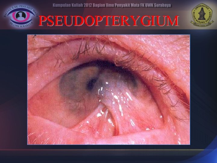 PSEUDOPTERYGIUM 
