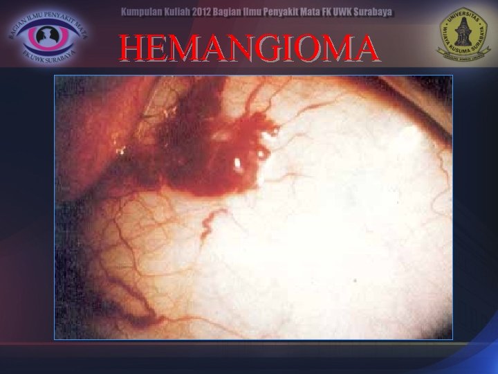 HEMANGIOMA 