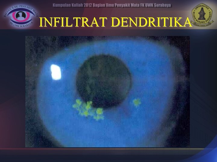 INFILTRAT DENDRITIKA 