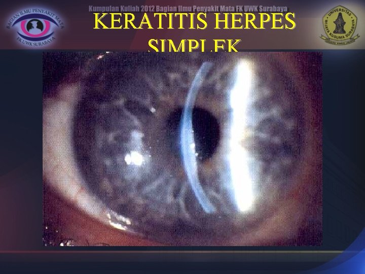 KERATITIS HERPES SIMPLEK 