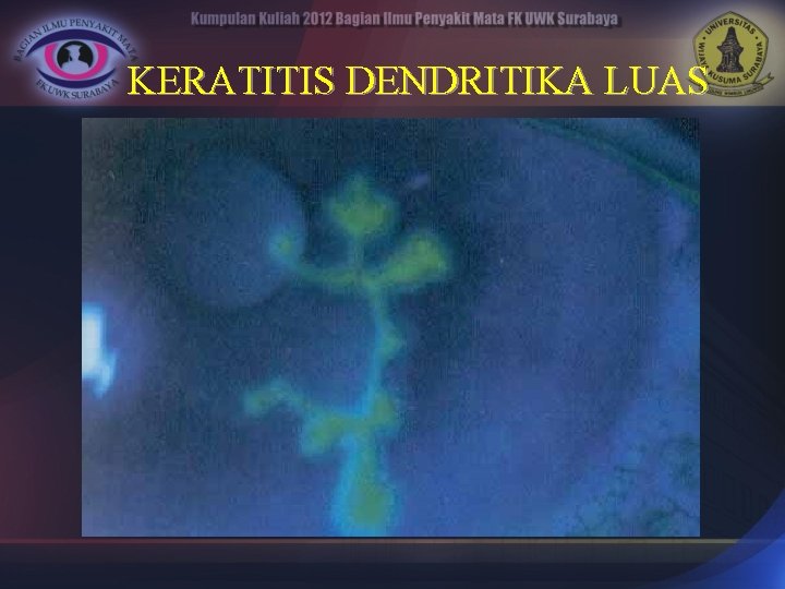 KERATITIS DENDRITIKA LUAS 