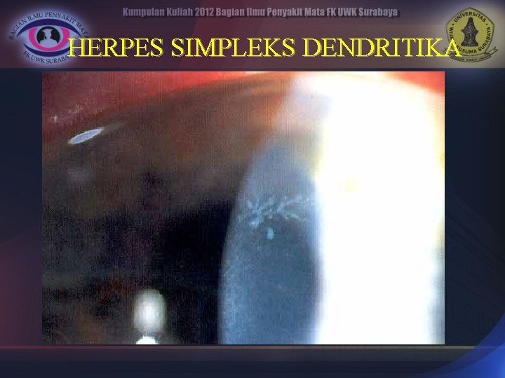 HERPES SIMPLEKS DENDRITIKA 