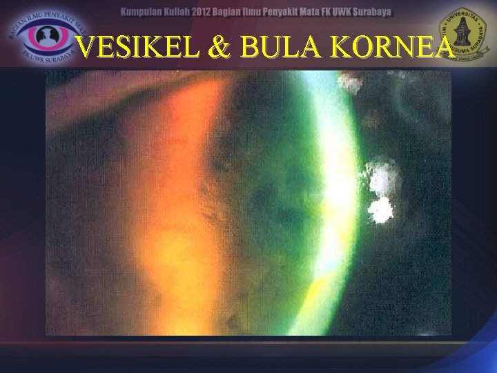 VESIKEL & BULA KORNEA 