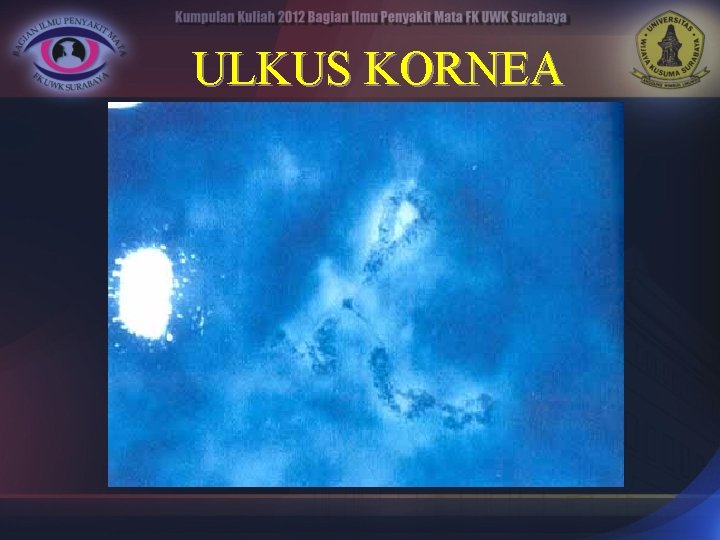 ULKUS KORNEA 