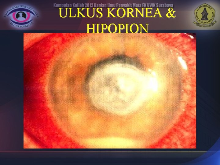 ULKUS KORNEA & HIPOPION 