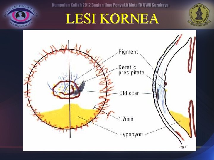 LESI KORNEA 