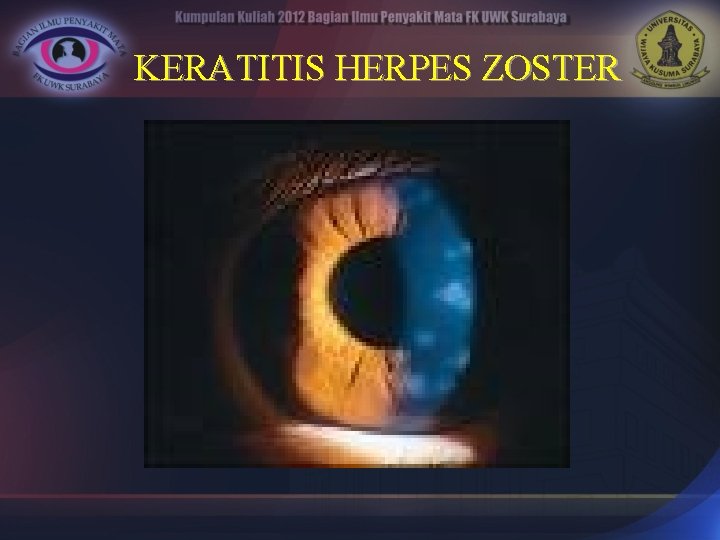 KERATITIS HERPES ZOSTER 