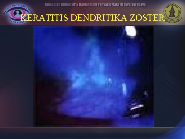 KERATITIS DENDRITIKA ZOSTER 