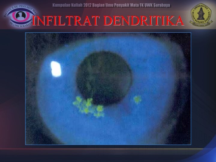 INFILTRAT DENDRITIKA 