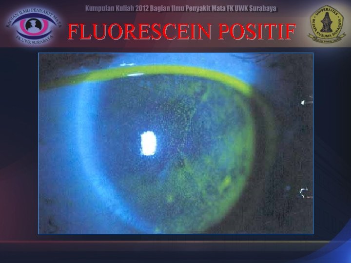 FLUORESCEIN POSITIF 