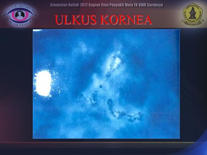 ULKUS KORNEA 