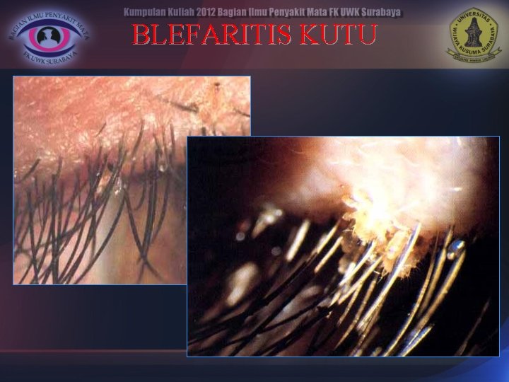 BLEFARITIS KUTU 