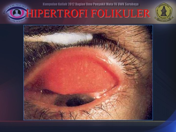 HIPERTROFI FOLIKULER 