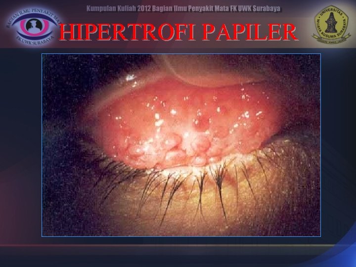 HIPERTROFI PAPILER 