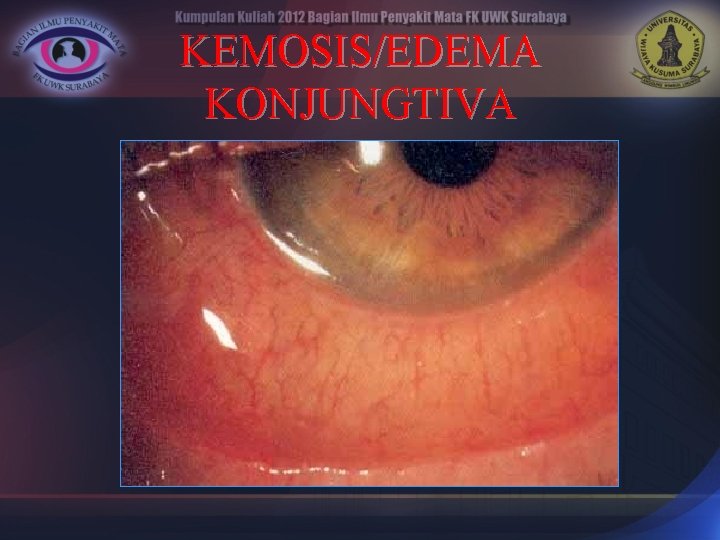 KEMOSIS/EDEMA KONJUNGTIVA 