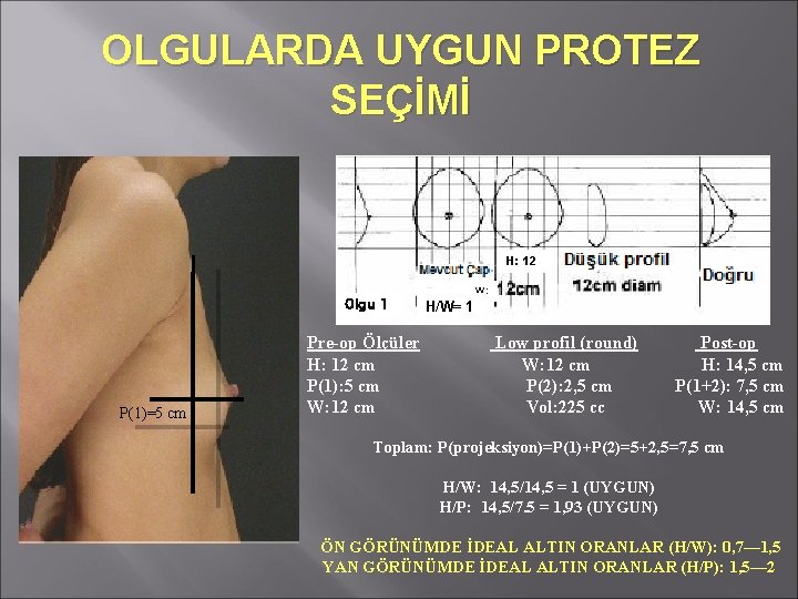 OLGULARDA UYGUN PROTEZ SEÇİMİ H: 12 Olgu 1 P(1)=5 cm Pre-op Ölçüler H: 12