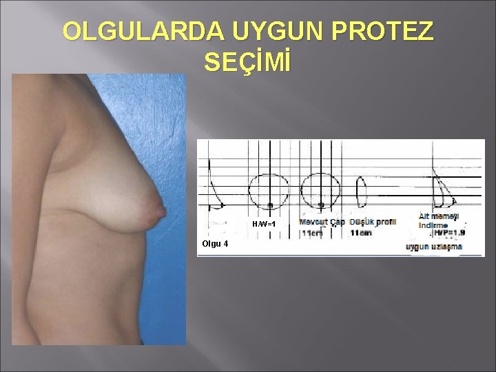 OLGULARDA UYGUN PROTEZ SEÇİMİ H/W=1 Olgu 4 