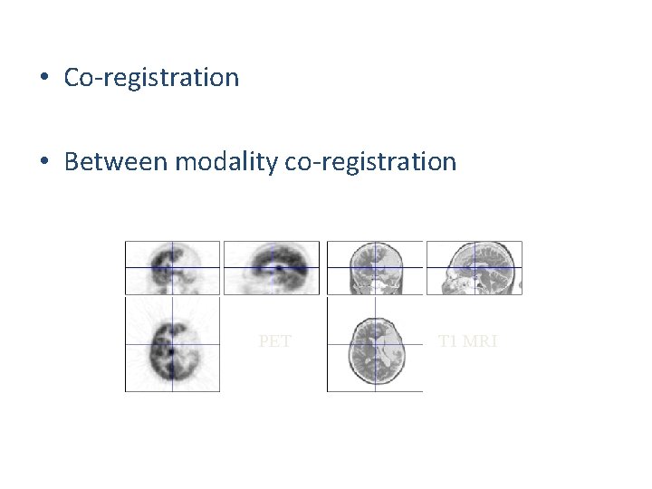  • Co-registration • Between modality co-registration PET T 1 MRI 