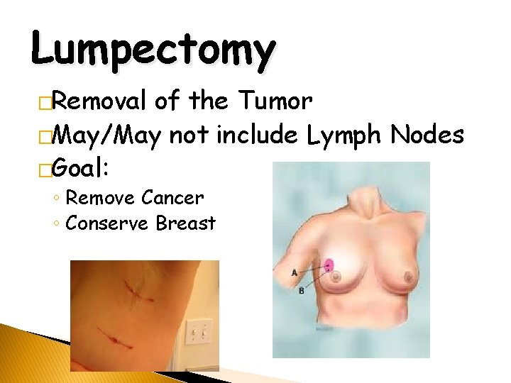 Lumpectomy �Removal of the Tumor �May/May not include Lymph Nodes �Goal: ◦ Remove Cancer
