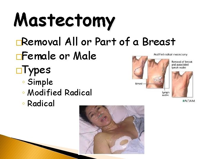 Mastectomy �Removal All or Part of a Breast �Female or Male �Types ◦ Simple