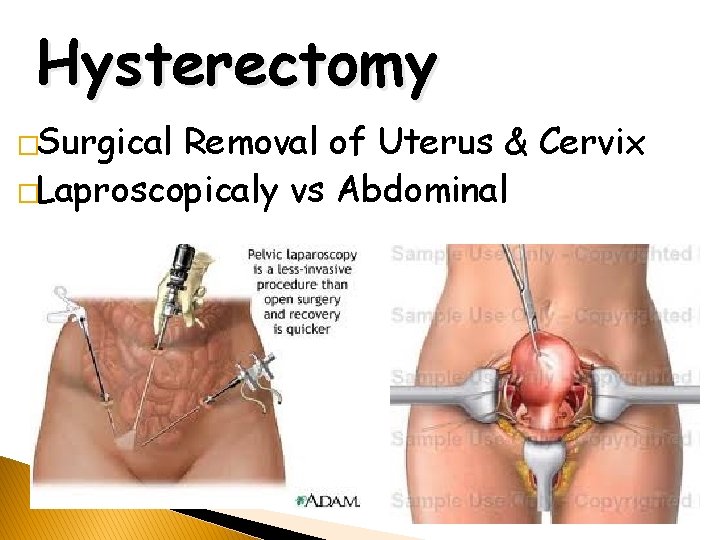 Hysterectomy �Surgical Removal of Uterus & Cervix �Laproscopicaly vs Abdominal 
