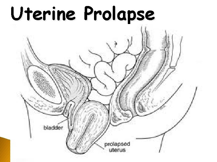 Uterine Prolapse 