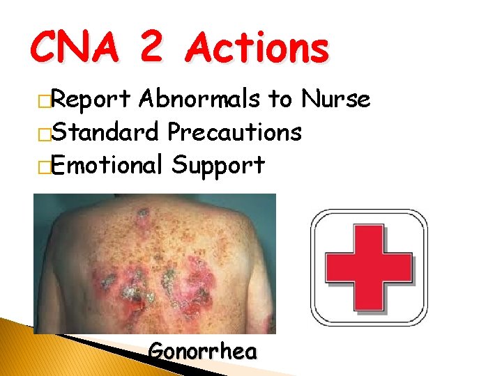 CNA 2 Actions �Report Abnormals to Nurse �Standard Precautions �Emotional Support Gonorrhea 