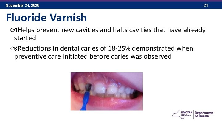 November 24, 2020 21 Fluoride Varnish Helps prevent new cavities and halts cavities that