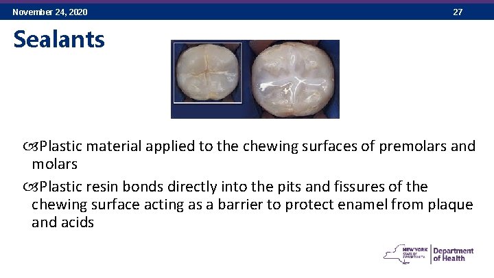 November 24, 2020 27 Sealants Plastic material applied to the chewing surfaces of premolars