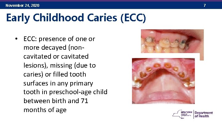 November 24, 2020 Early Childhood Caries (ECC) • ECC: presence of one or more