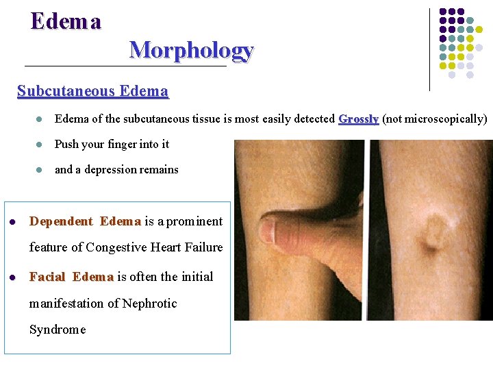 Edema Morphology Subcutaneous Edema l l Edema of the subcutaneous tissue is most easily