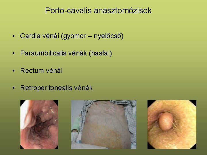 Porto-cavalis anasztomózisok • Cardia vénái (gyomor – nyelőcső) • Paraumbilicalis vénák (hasfal) • Rectum