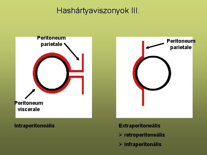 Hashártyaviszonyok III. Peritoneum parietale Peritoneum viscerale Intraperitoneális Extraperitoneális Ø retroperitoneális Ø infraperitonális 