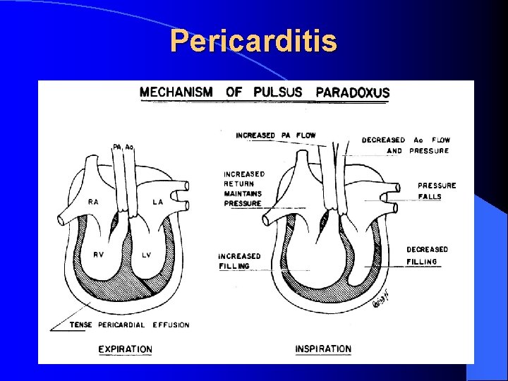 Pericarditis 