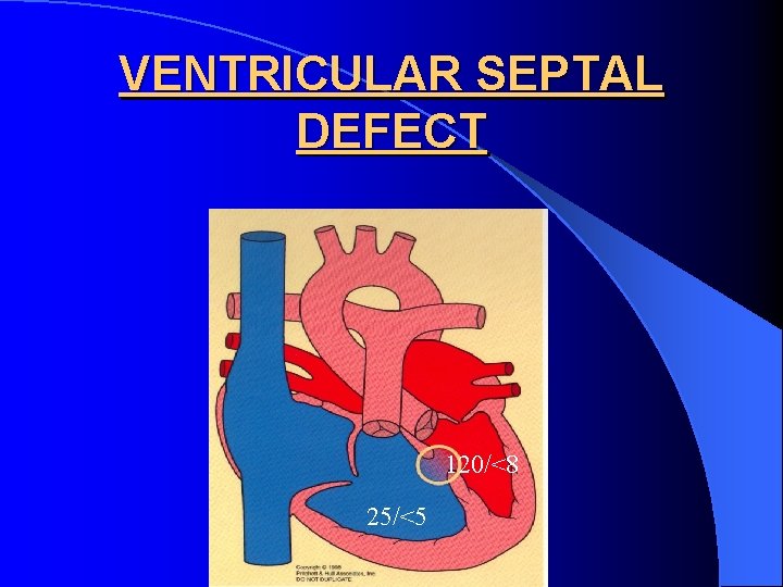 VENTRICULAR SEPTAL DEFECT 120/<8 25/<5 