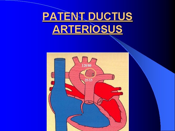 PATENT DUCTUS ARTERIOSUS 120/80 25/15 