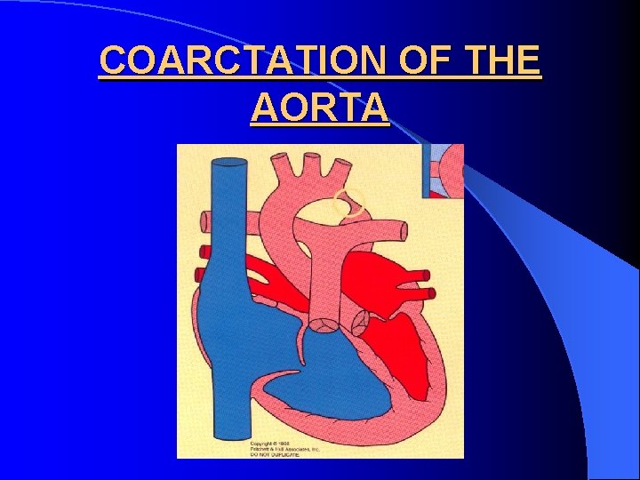 COARCTATION OF THE AORTA 