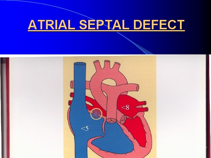 ATRIAL SEPTAL DEFECT <8 <5 