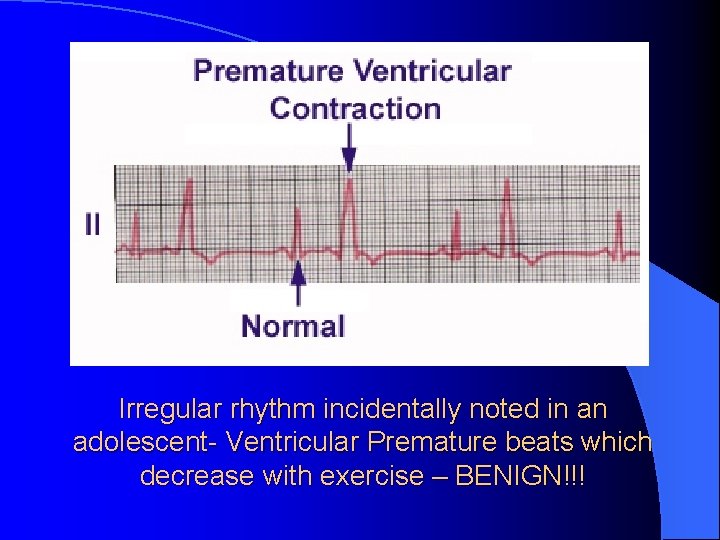 Irregular rhythm incidentally noted in an adolescent- Ventricular Premature beats which decrease with exercise