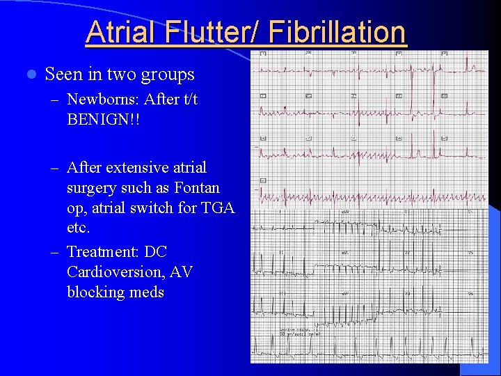 Atrial Flutter/ Fibrillation l Seen in two groups – Newborns: After t/t BENIGN!! –