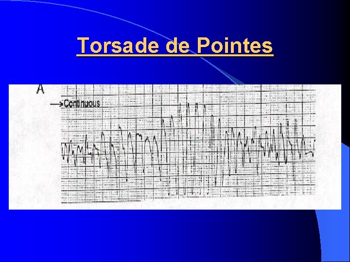 Torsade de Pointes 