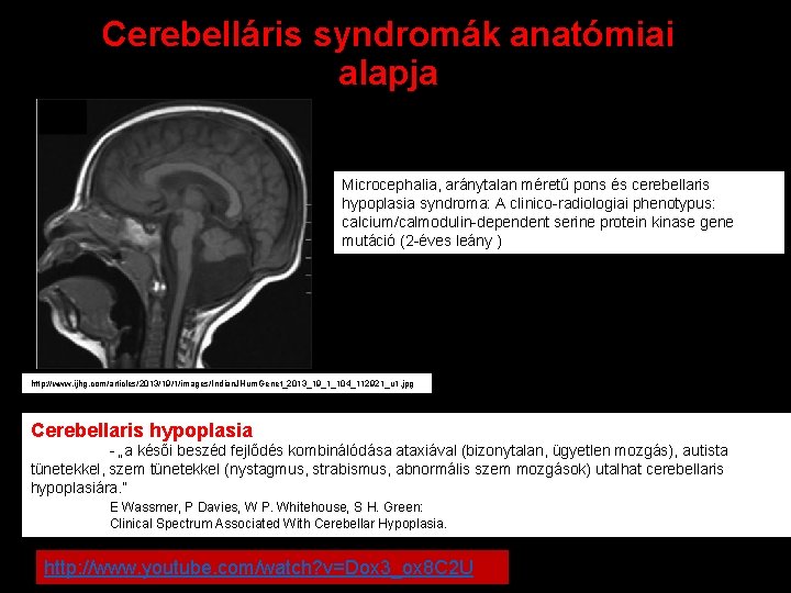 Cerebelláris syndromák anatómiai alapja Microcephalia, aránytalan méretű pons és cerebellaris hypoplasia syndroma: A clinico-radiologiai