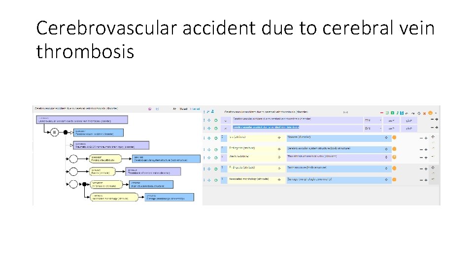 Cerebrovascular accident due to cerebral vein thrombosis 