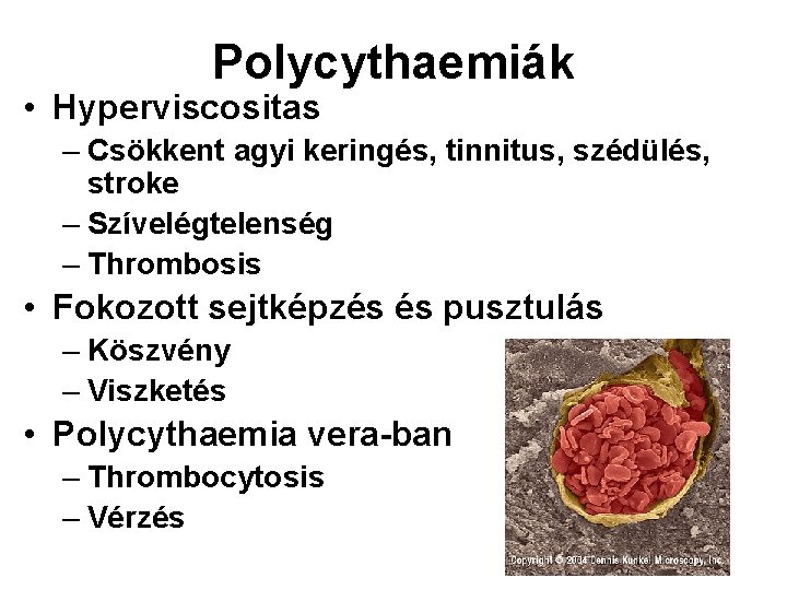 Polycythaemiák • Hyperviscositas – Csökkent agyi keringés, tinnitus, szédülés, stroke – Szívelégtelenség – Thrombosis Polycythaemiák • Hyperviscositas – Csökkent agyi keringés, tinnitus, szédülés, stroke – Szívelégtelenség – Thrombosis